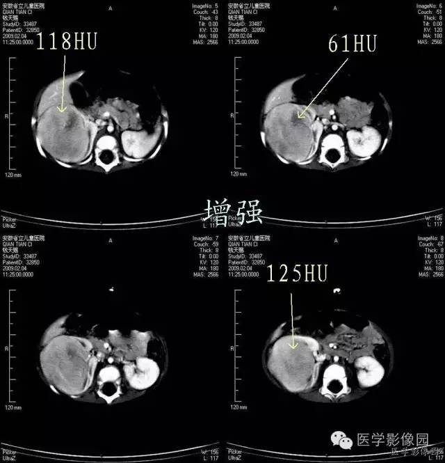 【病例】先天性中胚叶肾瘤1例CT影像表现 【病例】先天性中胚叶肾瘤1例CT影像表现