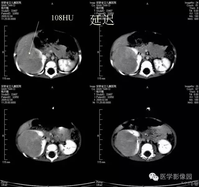 【病例】先天性中胚叶肾瘤1例CT影像表现 【病例】先天性中胚叶肾瘤1例CT影像表现
