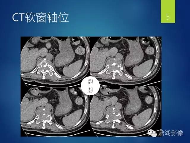 【病例】胸椎浆细胞瘤1例影像表现