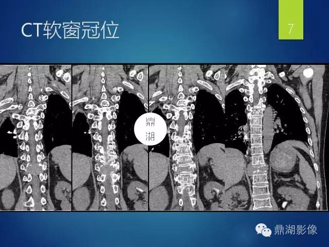 【病例】胸椎浆细胞瘤1例影像表现