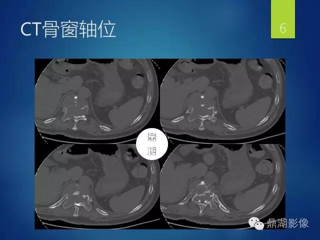 【病例】胸椎浆细胞瘤1例影像表现