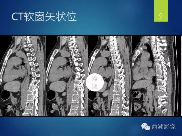 【病例】胸椎浆细胞瘤1例影像表现