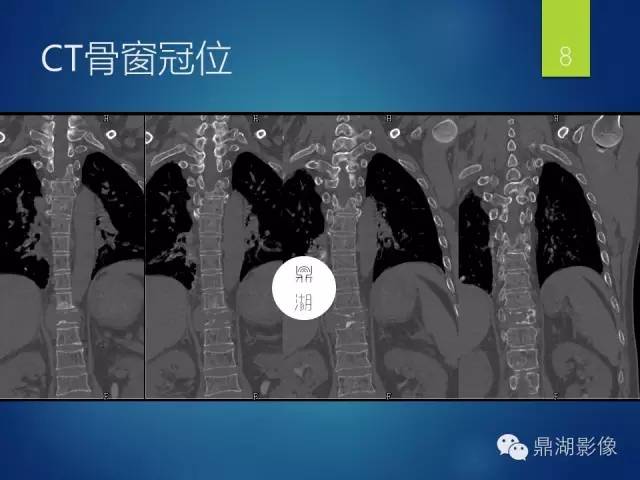 【病例】胸椎浆细胞瘤1例影像表现