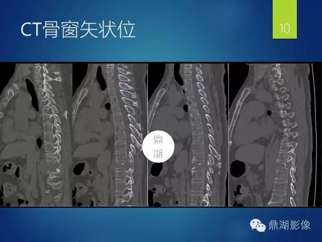 【病例】胸椎浆细胞瘤1例影像表现