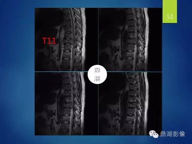 【病例】胸椎浆细胞瘤1例影像表现
