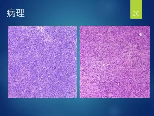 【病例】胸椎浆细胞瘤1例影像表现