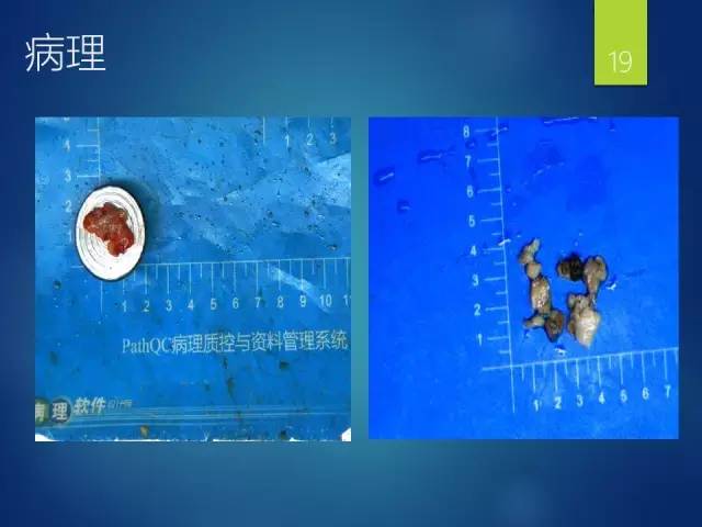 【病例】胸椎浆细胞瘤1例影像表现