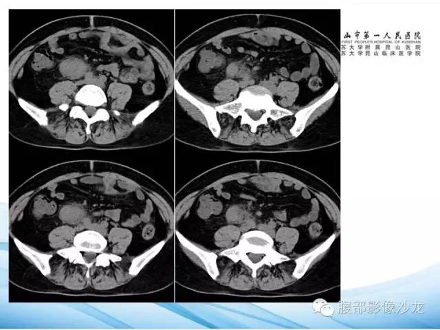 【病例】腹膜后平滑肌肉瘤1例CT影像表现 【病例】腹膜后平滑肌肉瘤1例CT影像表现