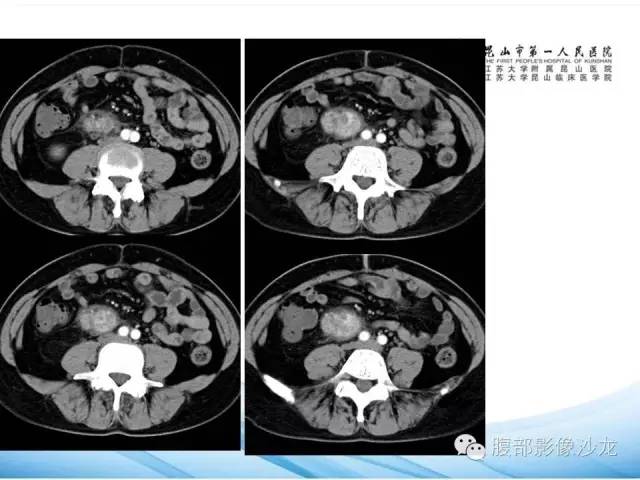 【病例】腹膜后平滑肌肉瘤1例CT影像表现 【病例】腹膜后平滑肌肉瘤1例CT影像表现