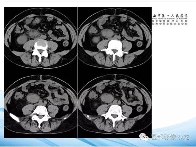 【病例】腹膜后平滑肌肉瘤1例CT影像表现 【病例】腹膜后平滑肌肉瘤1例CT影像表现