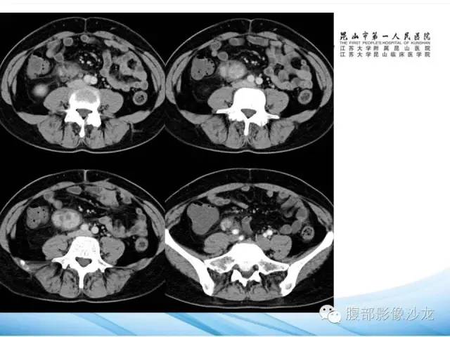 【病例】腹膜后平滑肌肉瘤1例CT影像表现 【病例】腹膜后平滑肌肉瘤1例CT影像表现