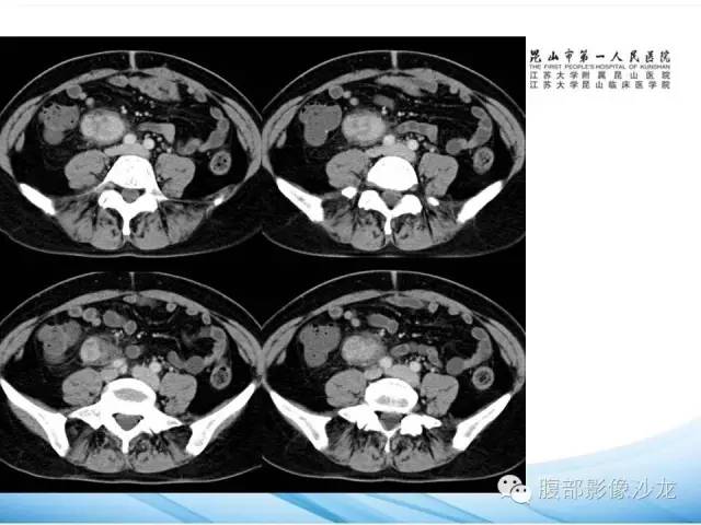 【病例】腹膜后平滑肌肉瘤1例CT影像表现 【病例】腹膜后平滑肌肉瘤1例CT影像表现