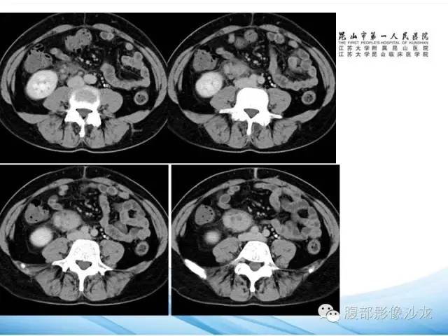 【病例】腹膜后平滑肌肉瘤1例CT影像表现 【病例】腹膜后平滑肌肉瘤1例CT影像表现