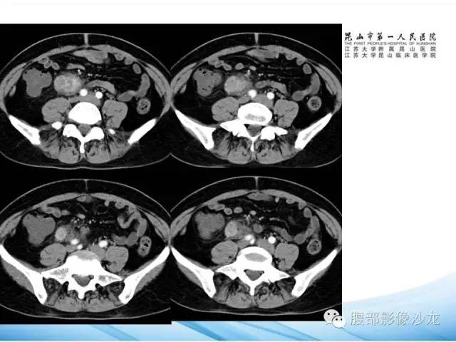 【病例】腹膜后平滑肌肉瘤1例CT影像表现 【病例】腹膜后平滑肌肉瘤1例CT影像表现