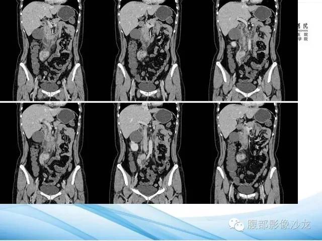 【病例】腹膜后平滑肌肉瘤1例CT影像表现 【病例】腹膜后平滑肌肉瘤1例CT影像表现