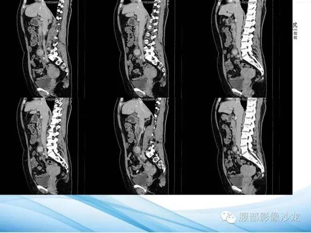 【病例】腹膜后平滑肌肉瘤1例CT影像表现 【病例】腹膜后平滑肌肉瘤1例CT影像表现