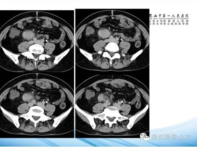 【病例】腹膜后平滑肌肉瘤1例CT影像表现 【病例】腹膜后平滑肌肉瘤1例CT影像表现