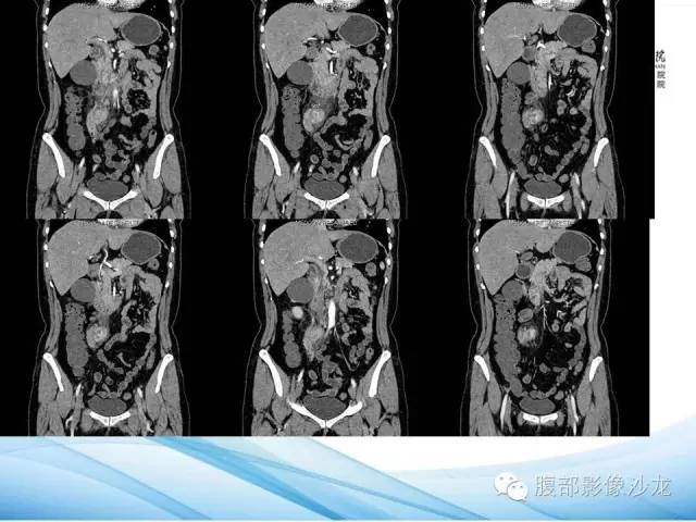 【病例】腹膜后平滑肌肉瘤1例CT影像表现 【病例】腹膜后平滑肌肉瘤1例CT影像表现