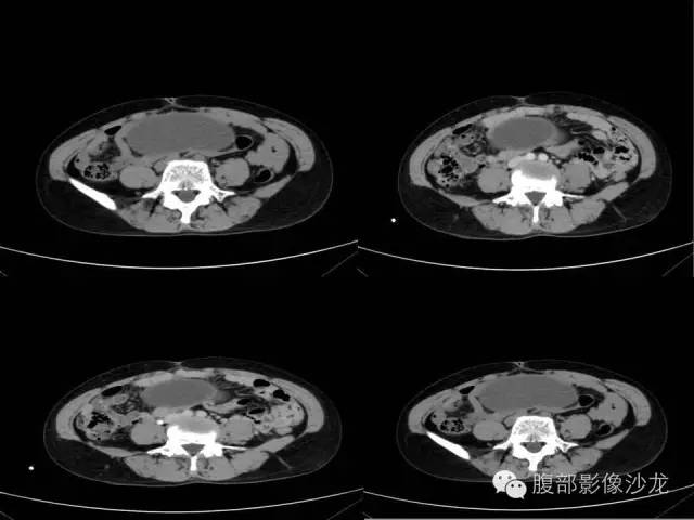 【病例】右侧卵巢囊性畸胎瘤1例CT及MR影像表现 【病例】右侧卵巢囊性畸胎瘤1例CT及MR影像表现