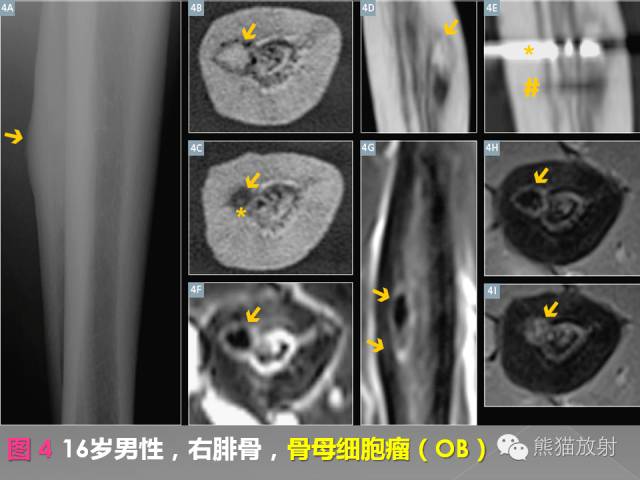 【PPT】良/恶性骨肿瘤影像表现及诊断