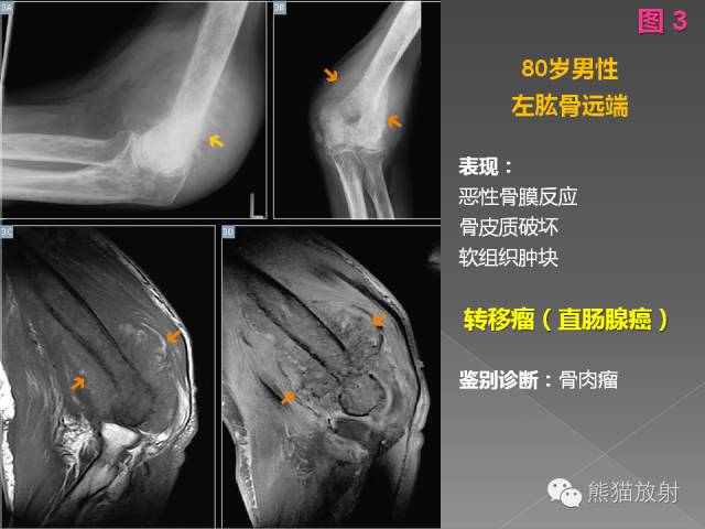 【PPT】良/恶性骨肿瘤影像表现及诊断