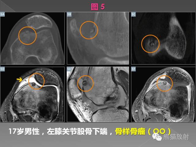 【PPT】良/恶性骨肿瘤影像表现及诊断