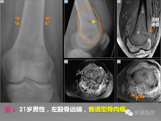 【PPT】良/恶性骨肿瘤影像表现及诊断