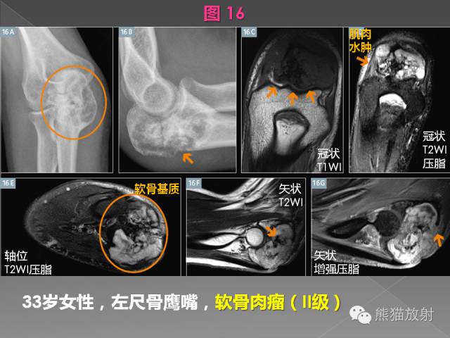 【PPT】良/恶性骨肿瘤影像表现及诊断