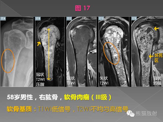 【PPT】良/恶性骨肿瘤影像表现及诊断