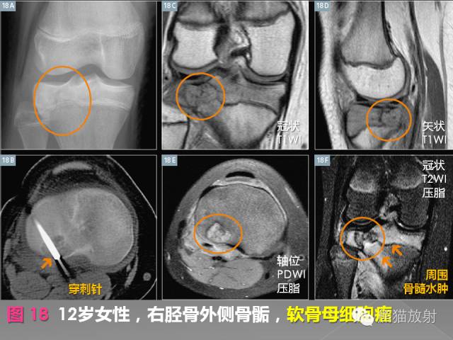 【PPT】良/恶性骨肿瘤影像表现及诊断