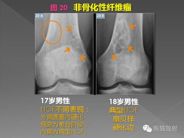 【PPT】良/恶性骨肿瘤影像表现及诊断