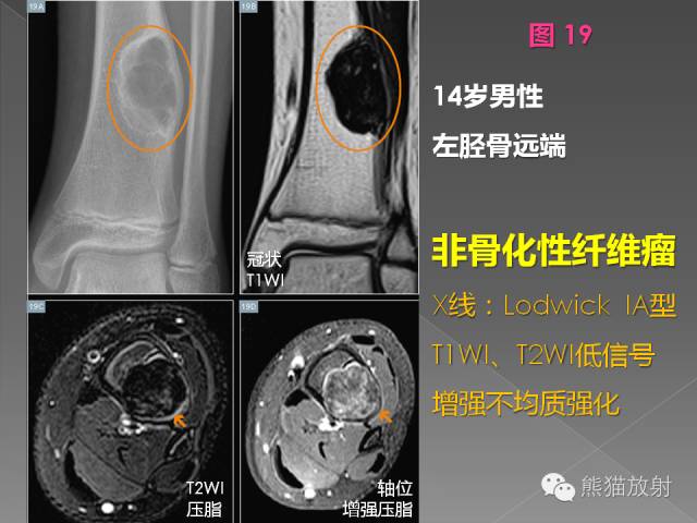 【PPT】良/恶性骨肿瘤影像表现及诊断