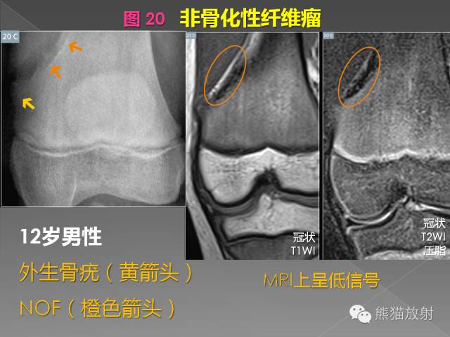 【PPT】良/恶性骨肿瘤影像表现及诊断