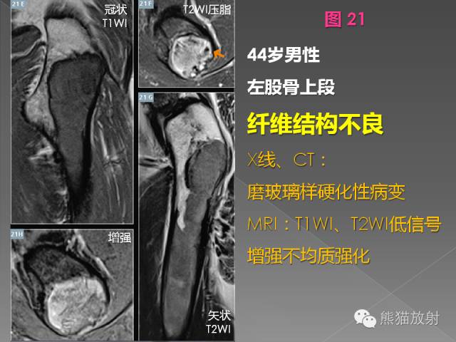 【PPT】良/恶性骨肿瘤影像表现及诊断