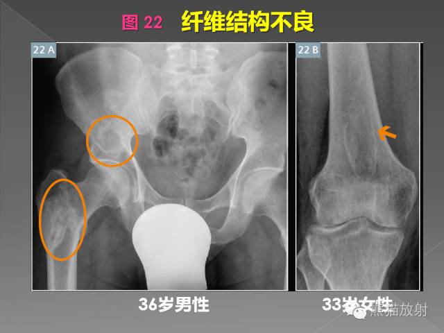 【PPT】良/恶性骨肿瘤影像表现及诊断