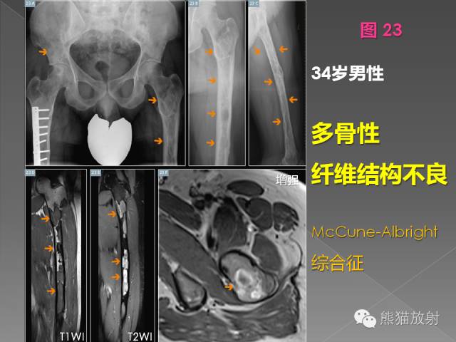【PPT】良/恶性骨肿瘤影像表现及诊断