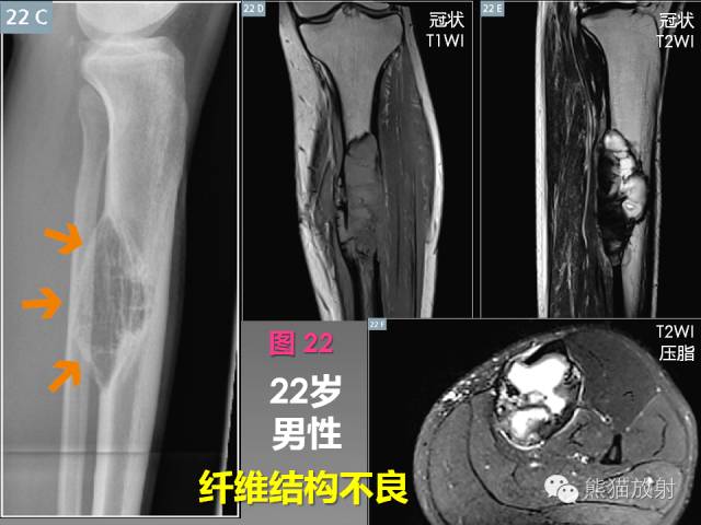 【PPT】良/恶性骨肿瘤影像表现及诊断