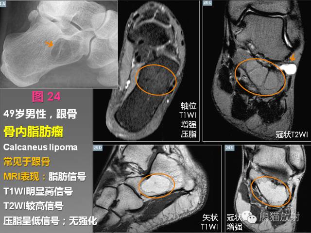 【PPT】良/恶性骨肿瘤影像表现及诊断