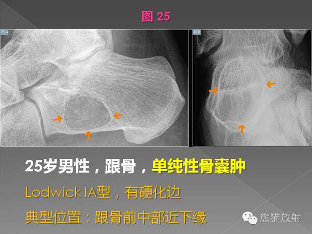 【PPT】良/恶性骨肿瘤影像表现及诊断