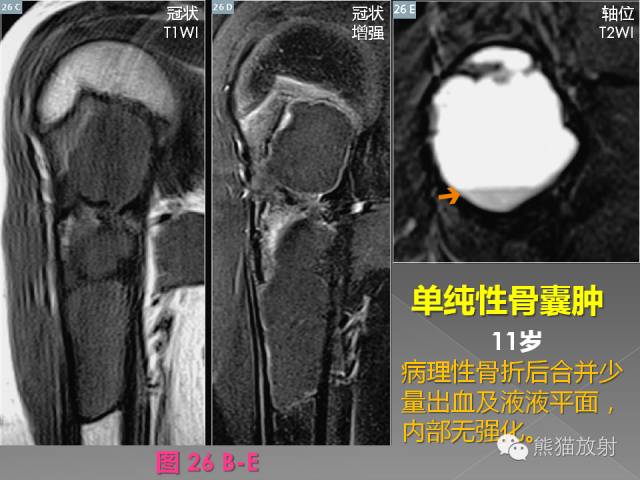 【PPT】良/恶性骨肿瘤影像表现及诊断