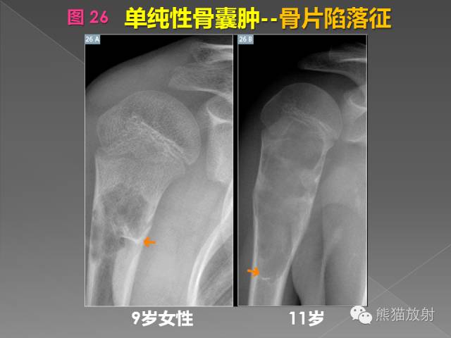【PPT】良/恶性骨肿瘤影像表现及诊断