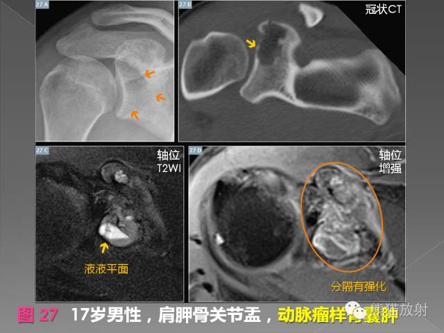 【PPT】良/恶性骨肿瘤影像表现及诊断
