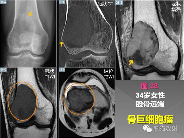 【PPT】良/恶性骨肿瘤影像表现及诊断