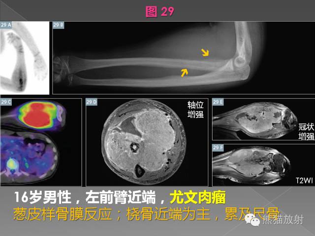 【PPT】良/恶性骨肿瘤影像表现及诊断