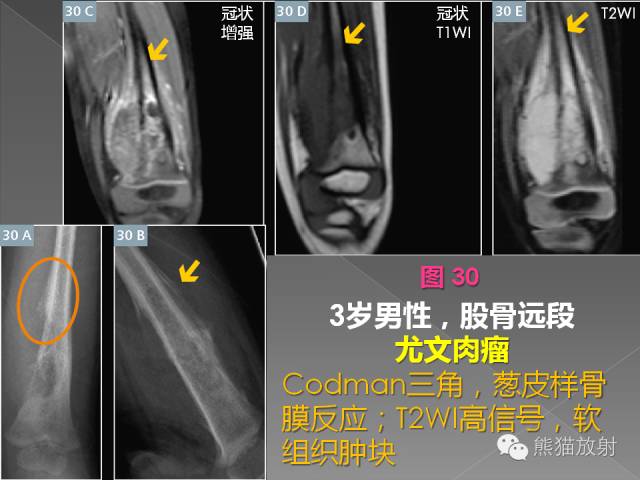 【PPT】良/恶性骨肿瘤影像表现及诊断
