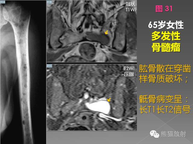 【PPT】良/恶性骨肿瘤影像表现及诊断