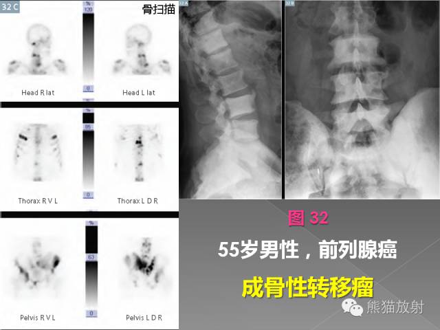 【PPT】良/恶性骨肿瘤影像表现及诊断
