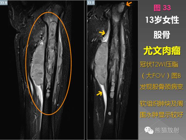 【PPT】良/恶性骨肿瘤影像表现及诊断