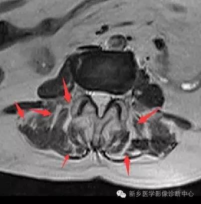 腰肌劳损也可以用磁共振看,向专家学习! 腰肌劳损也可以用磁共振看,向专家学习!