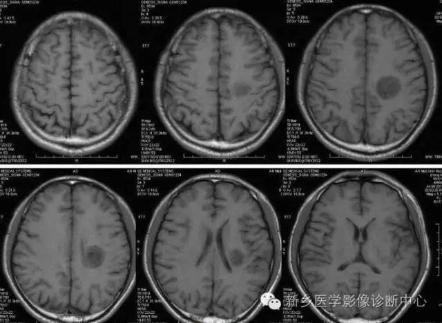 【读书笔记】脱髓鞘假瘤，一个有特征性的疾病